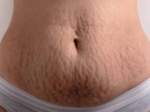 Natural Stetchmark Remedies