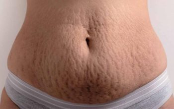 Natural Stetchmark Remedies